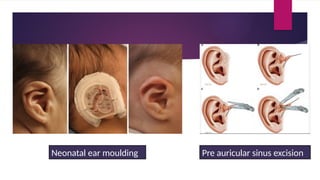 Development_of_Ear slide and congenital disease of external ear | PPTX