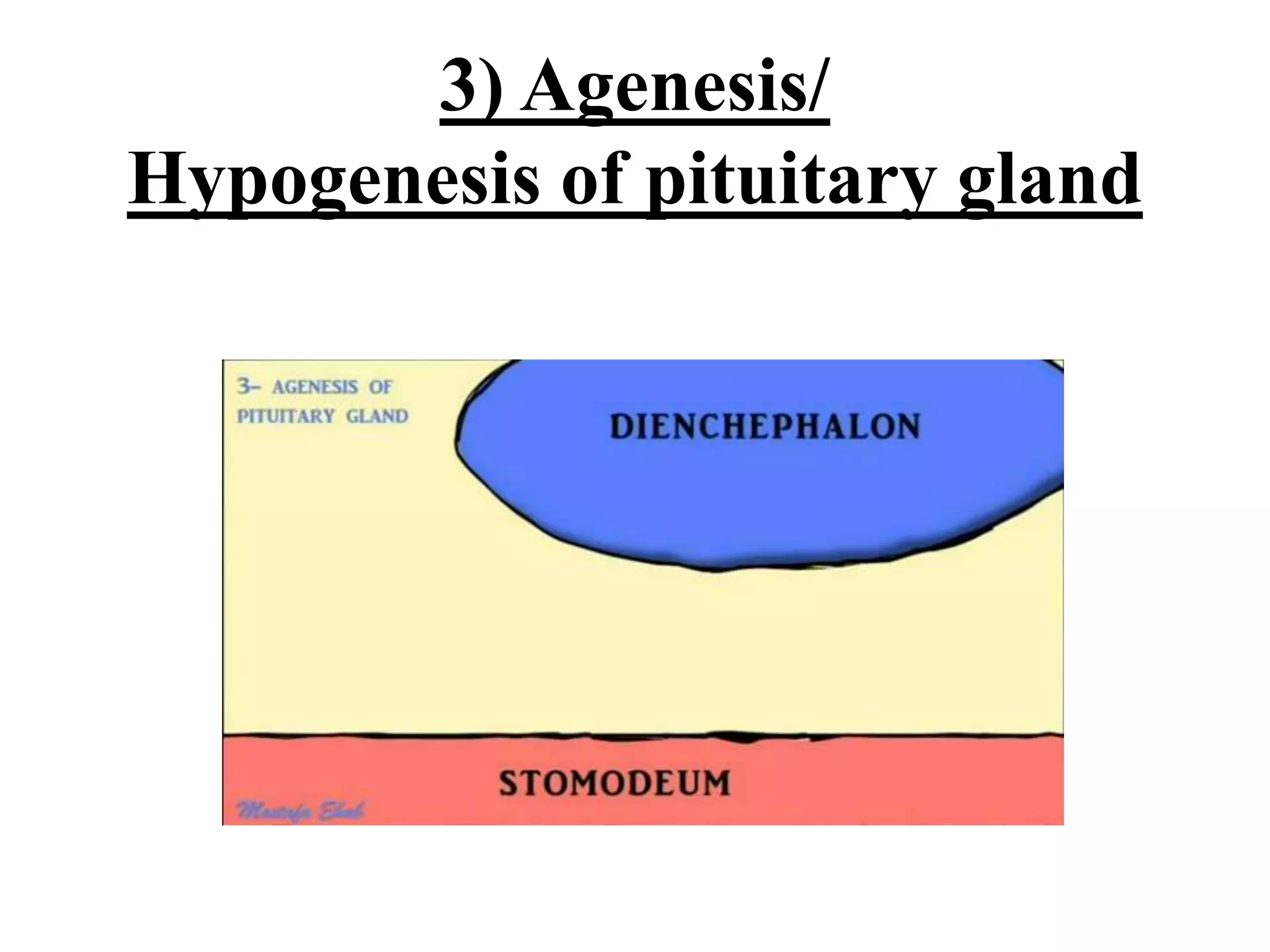3) Agenesis/
Hypogenesis of pituitary gland
 