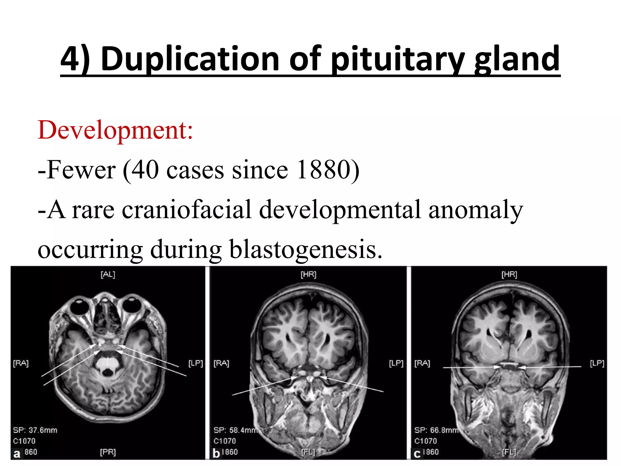 4) Duplication of pituitary gland
Development:
-Fewer (40 cases since 1880)
-A rare craniofacial developmental anomaly
occurring during blastogenesis.
 