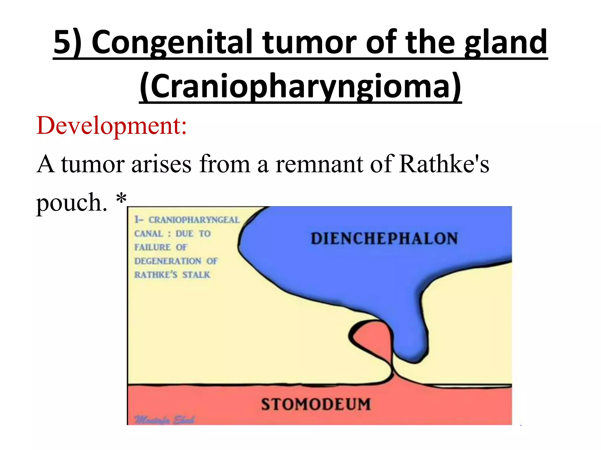 5) Congenital tumor of the gland
(Craniopharyngioma)
Development:
A tumor arises from a remnant of Rathke's
pouch. *
 