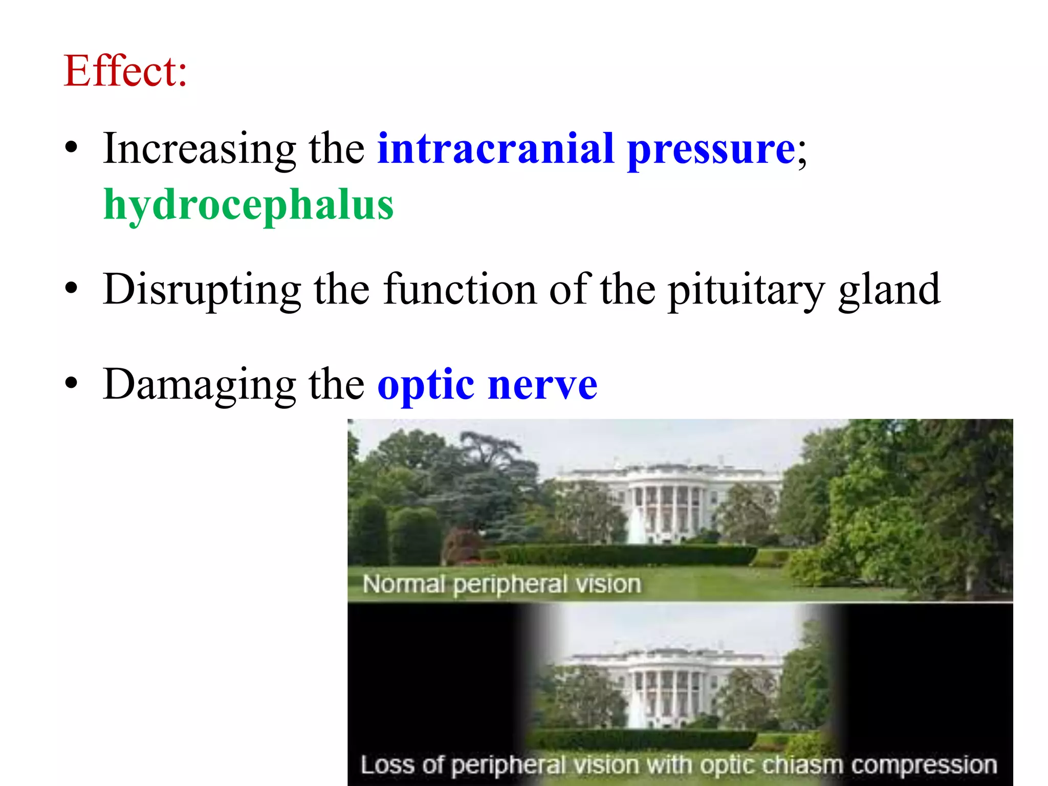 Effect:
• Increasing the intracranial pressure;
hydrocephalus
• Disrupting the function of the pituitary gland
• Damaging the optic nerve
 