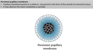 Ppm In Eye Development of eye | PPTX