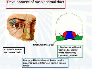 Development of nasolacrimal duct




                                 NASOLACRIMAL DUCT
                                                             - Develops as solid cord
– connects anterior                                          from medial angle of
eye to nasal cavity                                          eye to nasal cavity
                                                             - becomes canalized.

                      Obstructed Duct - failure of duct to canalize;
                      is opened surgically for tears to drain to nasal
                      cavity
 