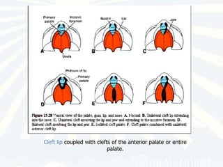 Cleft lip coupled with clefts of the anterior palate or entire
                            palate.
 