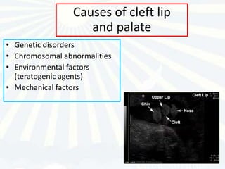 Causes of cleft lip
                    and palate
• Genetic disorders
• Chromosomal abnormalities
• Environmental factors
  (teratogenic agents)
• Mechanical factors
 