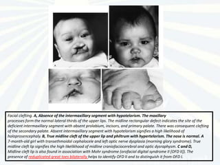 Facial clefting. A, Absence of the intermaxillary segment with hypotelorism. The maxillary
processes form the normal lateral thirds of the upper lips. The midline rectangular defect indicates the site of the
deficient intermaxillary segment with absent prolabium, incisors, and primary palate. There was consequent clefting
of the secondary palate. Absent intermaxillary segment with hypotelorism signifies a high likelihood of
holoprosencephaly. B, True midline cleft of the upper lip and philtrum with hypertelorism. The nose is normal. A
7-month-old girl with transethmoidal cephalocele and left optic nerve dysplasia (morning glory syndrome). True
midline cleft lip signifies the high likelikhood of midline craniofaciocerebral and optic dysraphysm. C and D,
Midline cleft lip is also found in association with Mohr syndrome (orofacial digital syndrome II [OFD II]). The
presence of reduplicated great toes bilaterally helps to identify OFD II and to distinguish it from OFD I.
 