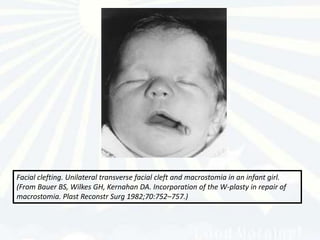 Facial clefting. Unilateral transverse facial cleft and macrostomia in an infant girl.
(From Bauer BS, Wilkes GH, Kernahan DA. Incorporation of the W-plasty in repair of
macrostomia. Plast Reconstr Surg 1982;70:752–757.)
 