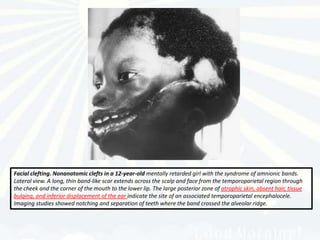 Facial clefting. Nonanatomic clefts in a 12-year-old mentally retarded girl with the syndrome of amnionic bands.
Lateral view. A long, thin band-like scar extends across the scalp and face from the temporoparietal region through
the cheek and the corner of the mouth to the lower lip. The large posterior zone of atrophic skin, absent hair, tissue
bulging, and inferior displacement of the ear indicate the site of an associated temporoparietal encephalocele.
Imaging studies showed notching and separation of teeth where the band crossed the alveolar ridge.
 