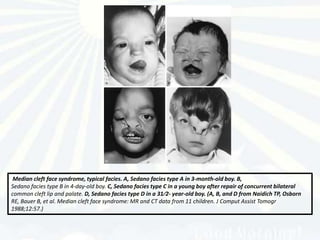Median cleft face syndrome, typical facies. A, Sedano facies type A in 3-month-old boy. B,
Sedano facies type B in 4-day-old boy. C, Sedano facies type C in a young boy after repair of concurrent bilateral
common cleft lip and palate. D, Sedano facies type D in a 31⁄2- year-old boy. (A, B, and D from Naidich TP, Osborn
RE, Bauer B, et al. Median cleft face syndrome: MR and CT data from 11 children. J Comput Assist Tomogr
1988;12:57.)
 