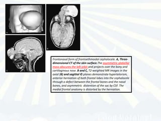 Frontonasal form of frontoethmoidal cephalocele. A, Three-
dimensional CT of the skin surface.The asymmetric glabellar
mass obscures the left orbit and projects over the bony and
cartilaginous nose. B and C, T2-weighted MR images in the
axial (B) and sagittal © planes demonstrate hypertelorism,
anterior herniation of both frontal lobes into the cephalocele
through a defect between the frontal bones and the nasal
bones, and asymmetric distention of the sac by CSF. The
medial frontal anatomy is distorted by the herniation.
 