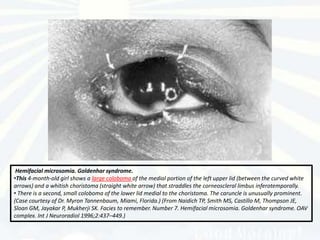Hemifacial microsomia. Goldenhar syndrome.
•This 4-month-old girl shows a large coloboma of the medial portion of the left upper lid (between the curved white
arrows) and a whitish choristoma (straight white arrow) that straddles the corneoscleral limbus inferotemporally.
• There is a second, small coloboma of the lower lid medial to the choristoma. The caruncle is unusually prominent.
(Case courtesy of Dr. Myron Tannenbaum, Miami, Florida.) (From Naidich TP, Smith MS, Castillo M, Thompson JE,
Sloan GM, Jayakar P, Mukherji SK. Facies to remember. Number 7. Hemifacial microsomia. Goldenhar syndrome. OAV
complex. Int J Neuroradiol 1996;2:437–449.)
 