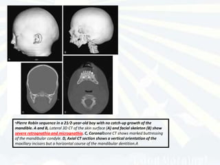 •Pierre Robin sequence in a 21⁄2-year-old boy with no catch-up growth of the
mandible. A and B, Lateral 3D CT of the skin surface (A) and facial skeleton (B) show
severe retrognathia and micrognathia. C, Coronalbone CT shows marked buttressing
of the mandibular condyle. D, Axial CT section shows a vertical orientation of the
maxillary incisors but a horizontal course of the mandibular dentition.A
 