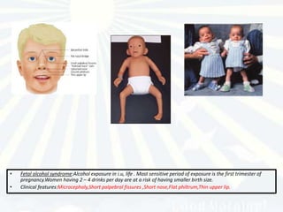 •   Fetal alcohol syndrome:Alcohol exposure in i.u, life . Most sensitive period of exposure is the first trimester of
    pregnancy.Women having 2 – 4 drinks per day are at a risk of having smaller birth size.
•   Clinical features:Microcephaly,Short palpebral fissures ,Short nose,Flat philtrum,Thin upper lip.
 