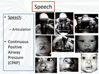 Speech
• Speech:

  – Articulation


• Continuous
  Positive
  Airway
  Pressure
  (CPAP)
 