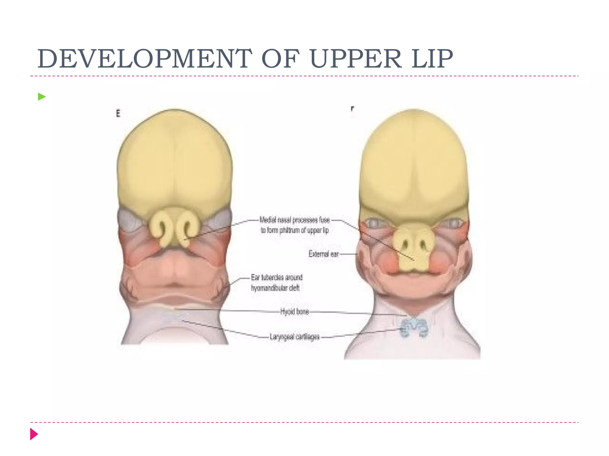 DEVELOPMENT OF UPPER LIP


 