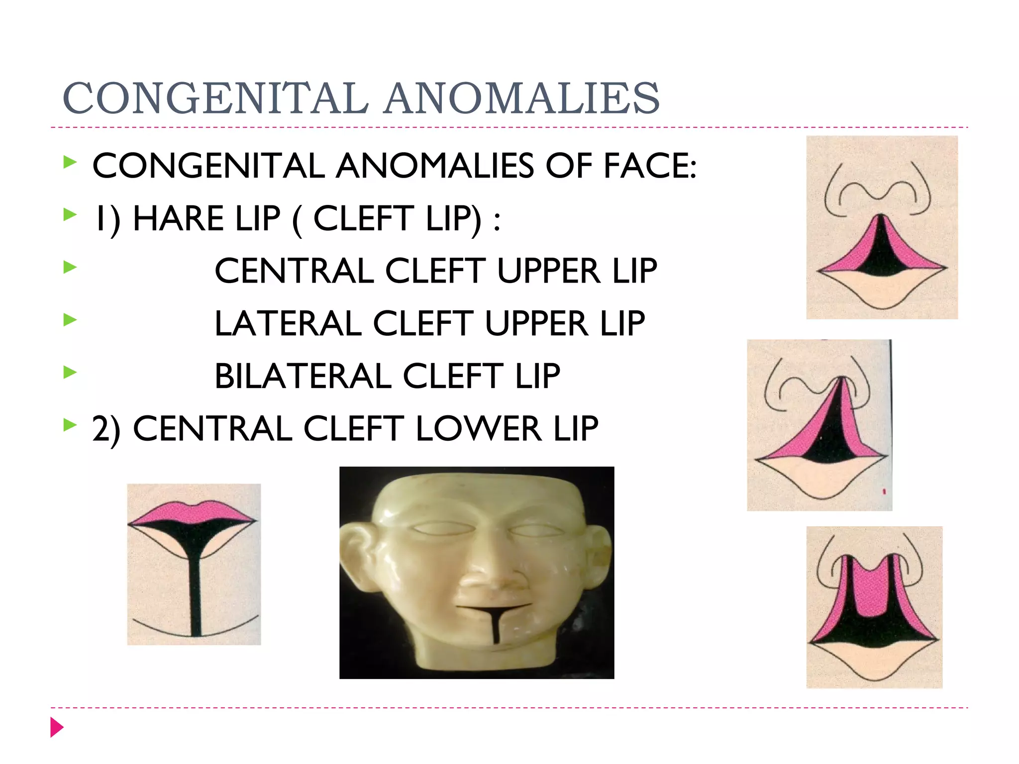 CONGENITAL ANOMALIES







CONGENITAL ANOMALIES OF FACE:
1) HARE LIP ( CLEFT LIP) :
CENTRAL CLEFT UPPER LIP
LATERAL CLEFT UPPER LIP
BILATERAL CLEFT LIP
2) CENTRAL CLEFT LOWER LIP

 