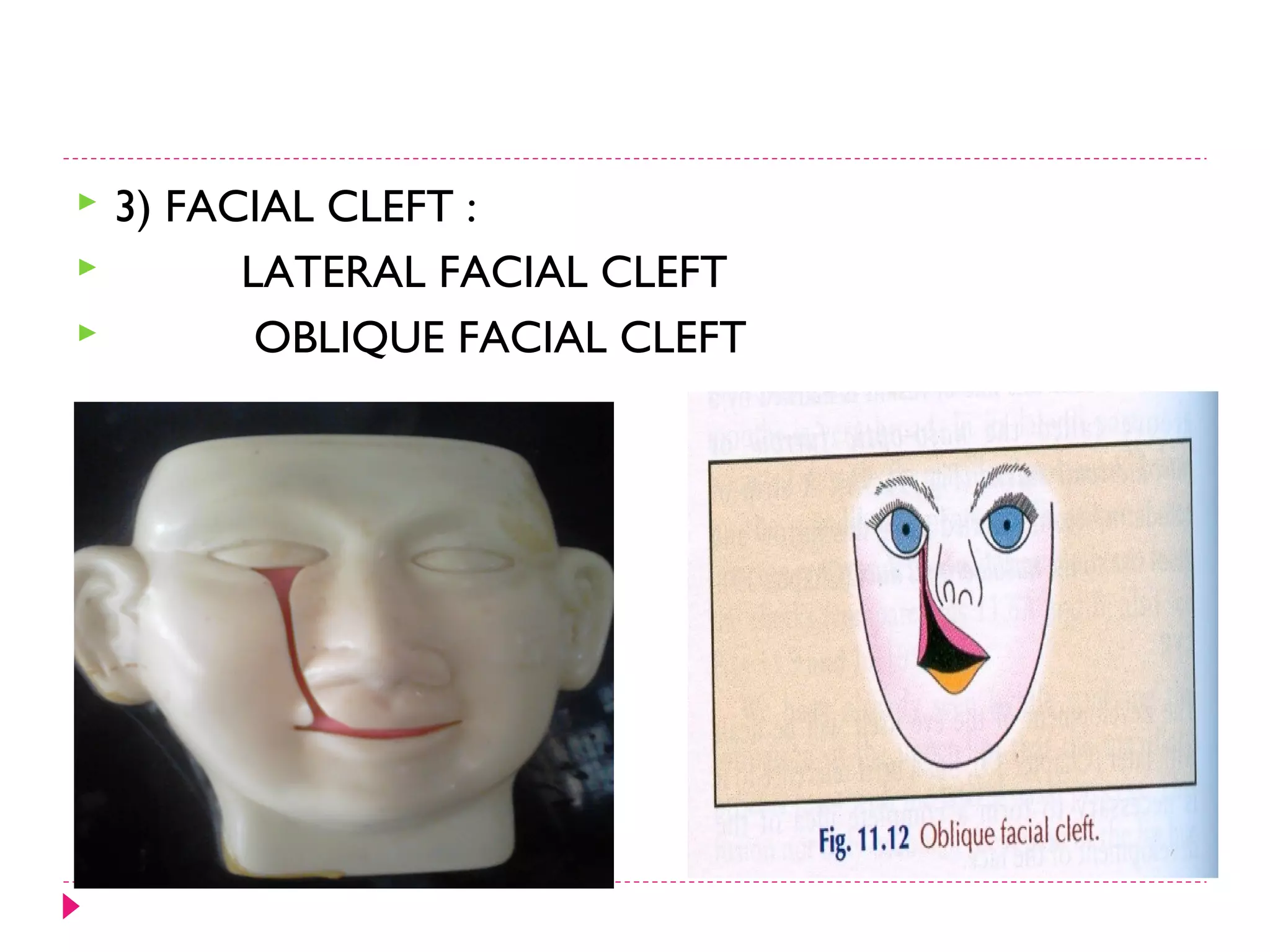 



3) FACIAL CLEFT :
LATERAL FACIAL CLEFT
OBLIQUE FACIAL CLEFT

 