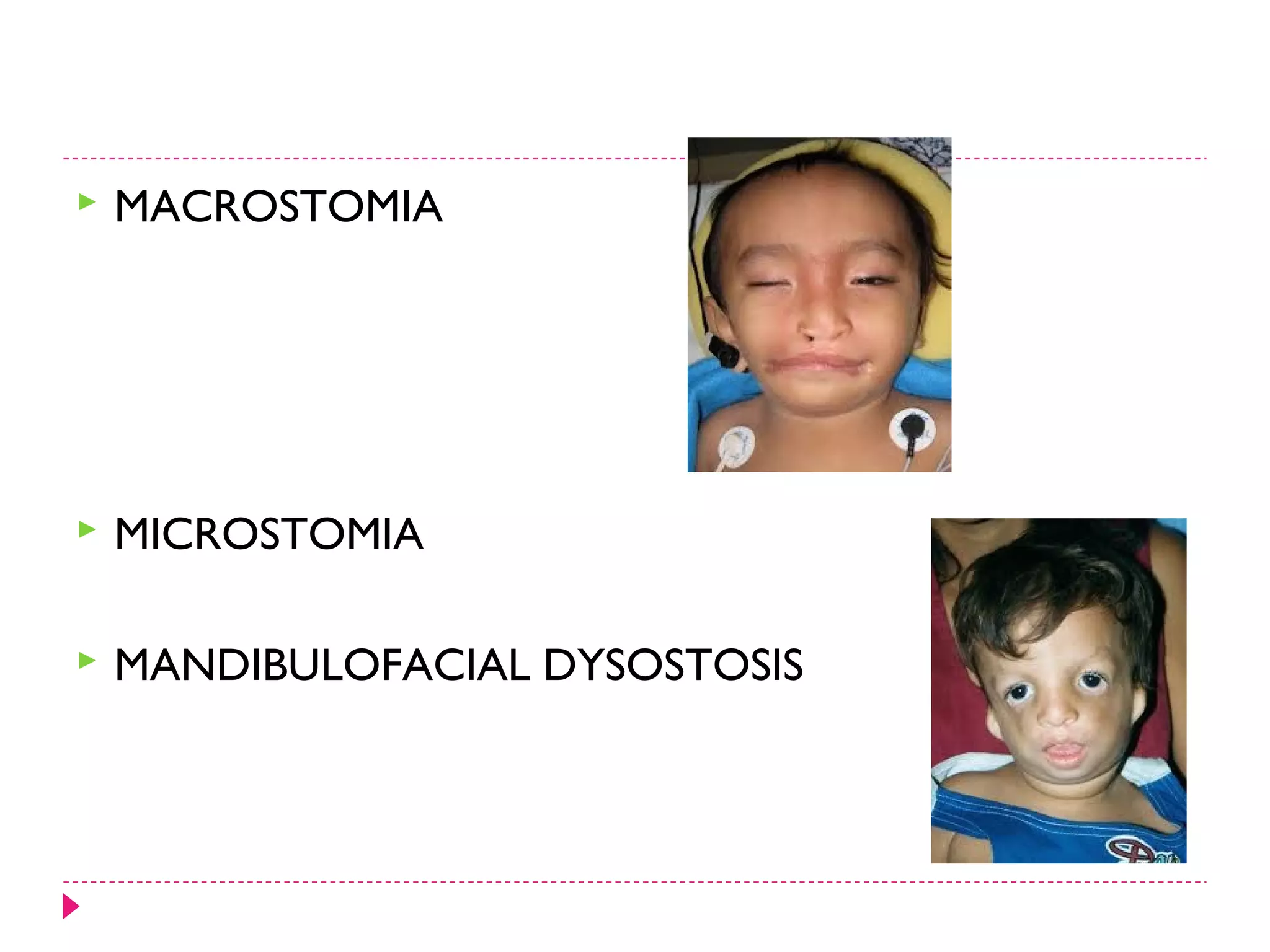 

MACROSTOMIA



MICROSTOMIA



MANDIBULOFACIAL DYSOSTOSIS

 