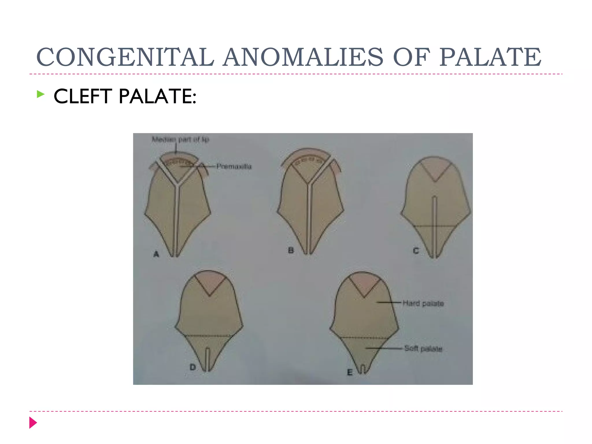 CONGENITAL ANOMALIES OF PALATE


CLEFT PALATE:

 