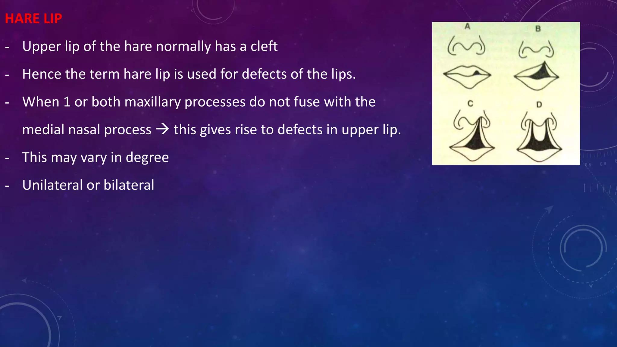 HARE LIP
- Upper lip of the hare normally has a cleft
- Hence the term hare lip is used for defects of the lips.
- When 1 or both maxillary processes do not fuse with the
medial nasal process  this gives rise to defects in upper lip.
- This may vary in degree
- Unilateral or bilateral
 