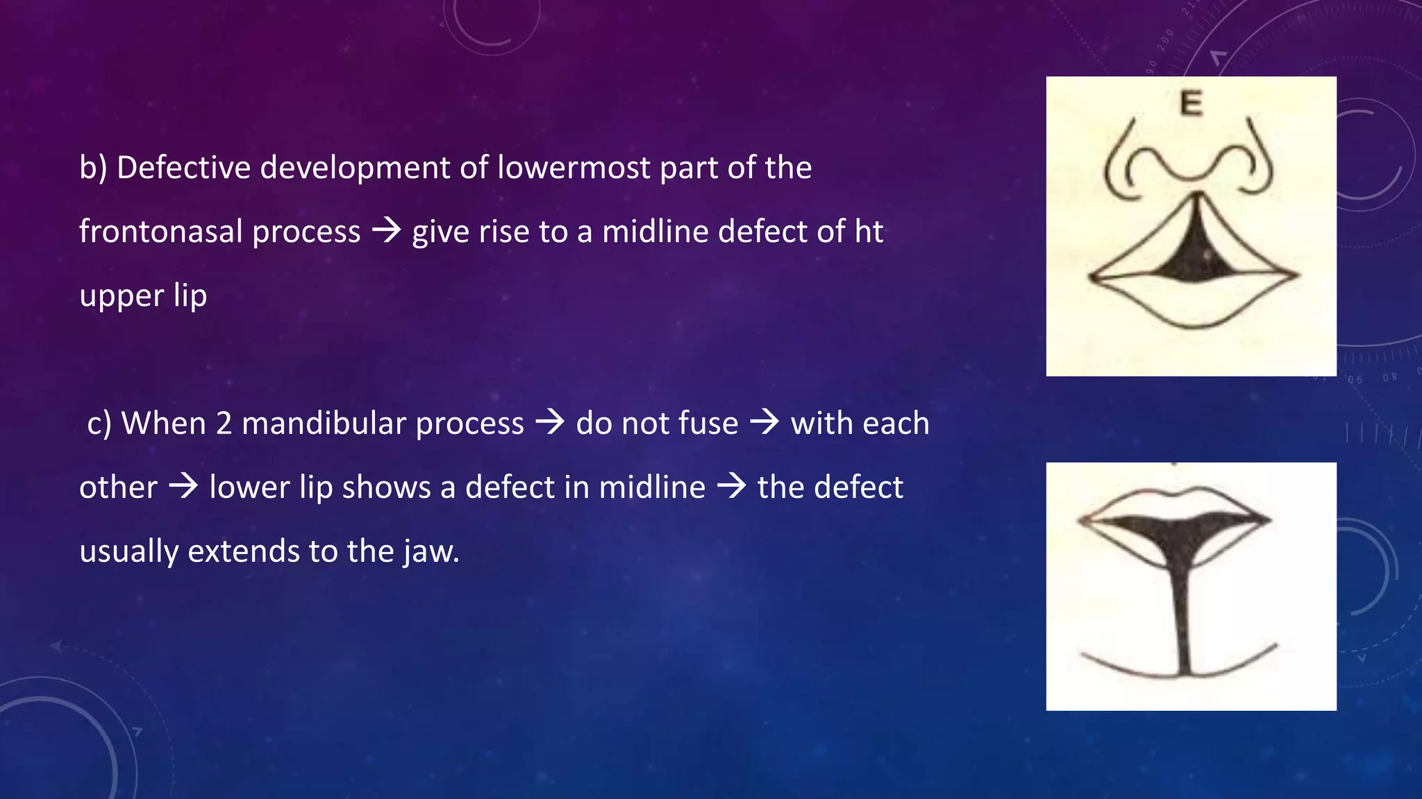 b) Defective development of lowermost part of the
frontonasal process  give rise to a midline defect of ht
upper lip
c) When 2 mandibular process  do not fuse  with each
other  lower lip shows a defect in midline  the defect
usually extends to the jaw.
 
