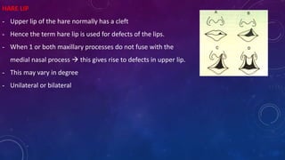 HARE LIP
- Upper lip of the hare normally has a cleft
- Hence the term hare lip is used for defects of the lips.
- When 1 or both maxillary processes do not fuse with the
medial nasal process  this gives rise to defects in upper lip.
- This may vary in degree
- Unilateral or bilateral
 