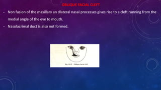 OBLIQUE FACIAL CLEFT
- Non fusion of the maxillary an dlateral nasal processes gives rise to a cleft running from the
medial angle of the eye to mouth.
- Nasolacrimal duct is also not formed.
 
