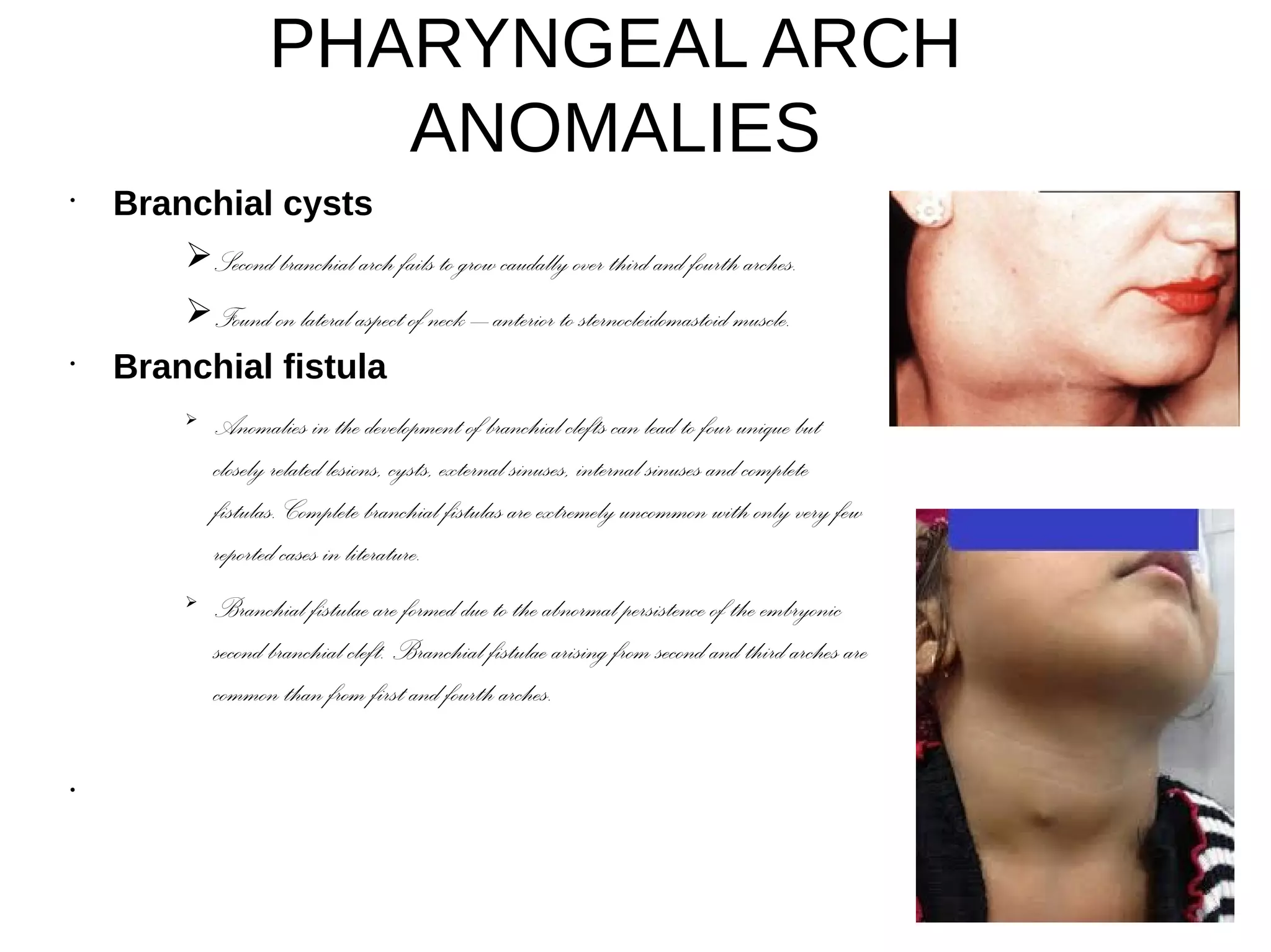 PHARYNGEAL ARCH
ANOMALIES
•
Branchial cysts
➢Second branchial arch fails to grow caudally over third and fourth arches.
➢Found on lateral aspect of neck – anterior to sternocleidomastoid muscle.
•
Branchial fistula
➢
Anomalies in the development of branchial clefts can lead to four unique but
closely related lesions, cysts, external sinuses, internal sinuses and complete
fistulas. Complete branchial fistulas are extremely uncommon with only very few
reported cases in literature.
➢
Branchial fistulae are formed due to the abnormal persistence of the embryonic
second branchial cleft. Branchial fistulae arising from second and third arches are
common than from first and fourth arches.
•
 
