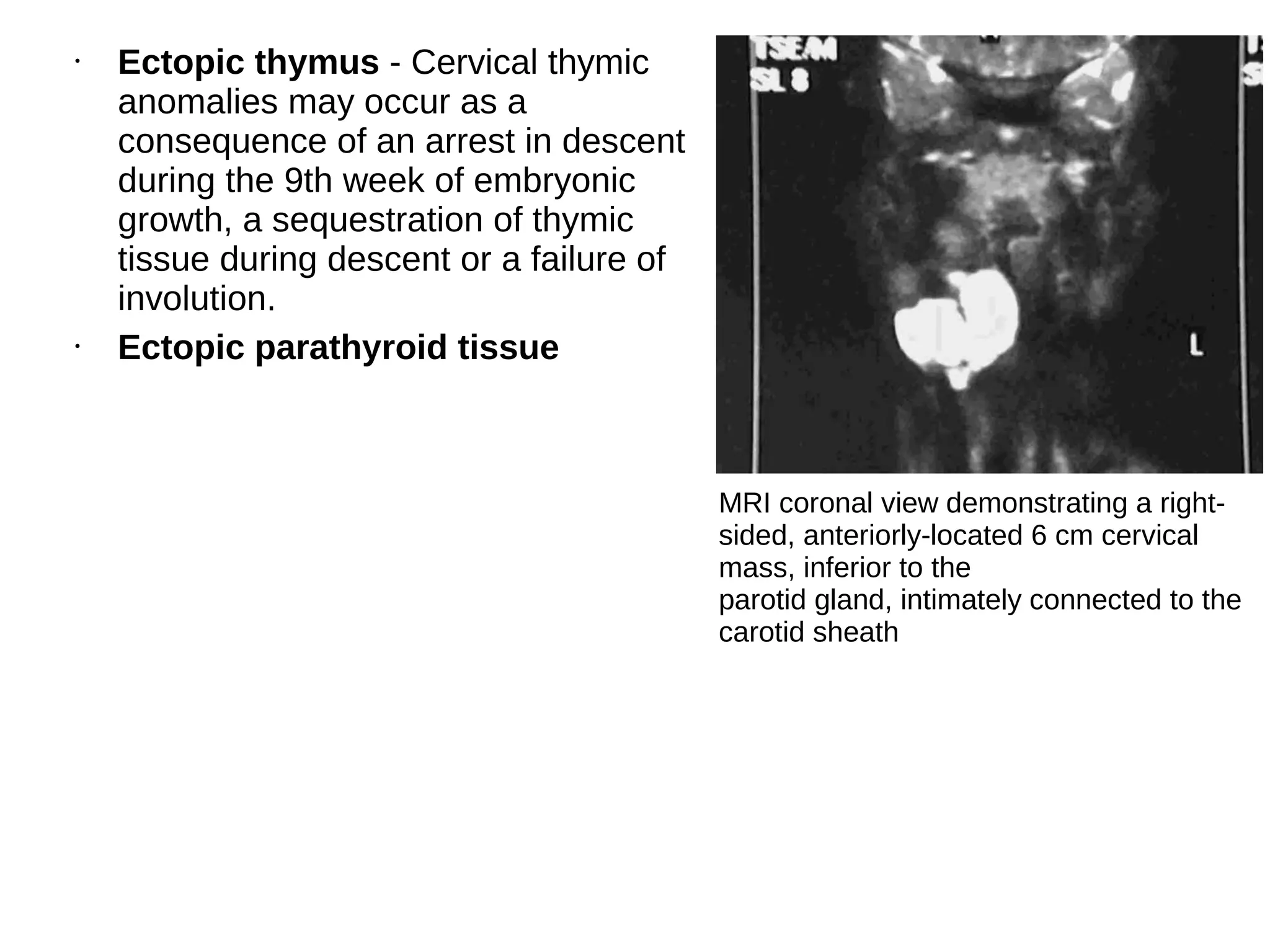 • Ectopic thymus - Cervical thymic
anomalies may occur as a
consequence of an arrest in descent
during the 9th week of embryonic
growth, a sequestration of thymic
tissue during descent or a failure of
involution.
• Ectopic parathyroid tissue
MRI coronal view demonstrating a right-
sided, anteriorly-located 6 cm cervical
mass, inferior to the
parotid gland, intimately connected to the
carotid sheath
 