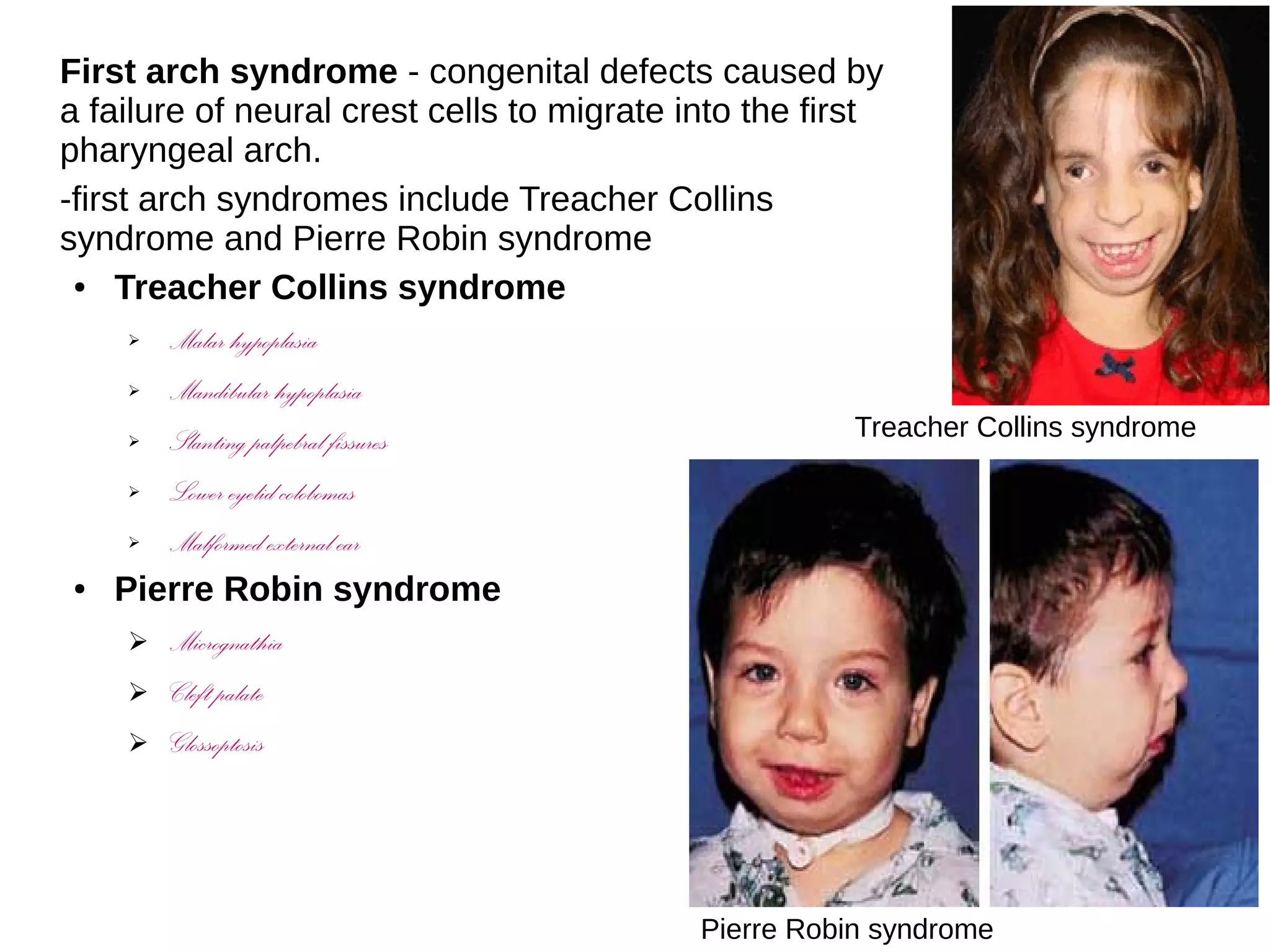 First arch syndrome - congenital defects caused by
a failure of neural crest cells to migrate into the first
pharyngeal arch.
-first arch syndromes include Treacher Collins
syndrome and Pierre Robin syndrome
● Treacher Collins syndrome
➢ Malar hypoplasia
➢ Mandibular hypoplasia
➢ Slanting palpebral fissures
➢ Lower eyelid colobomas
➢ Malformed external ear
● Pierre Robin syndrome
➢ Micrognathia
➢ Cleft palate
➢ Glossoptosis
Treacher Collins syndrome
Pierre Robin syndrome
 