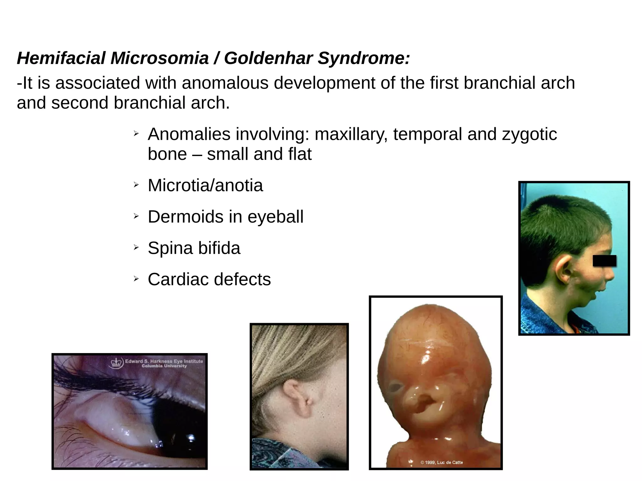 Hemifacial Microsomia / Goldenhar Syndrome:
-It is associated with anomalous development of the first branchial arch
and second branchial arch.
➢ Anomalies involving: maxillary, temporal and zygotic
bone – small and flat
➢ Microtia/anotia
➢ Dermoids in eyeball
➢ Spina bifida
➢ Cardiac defects
 
