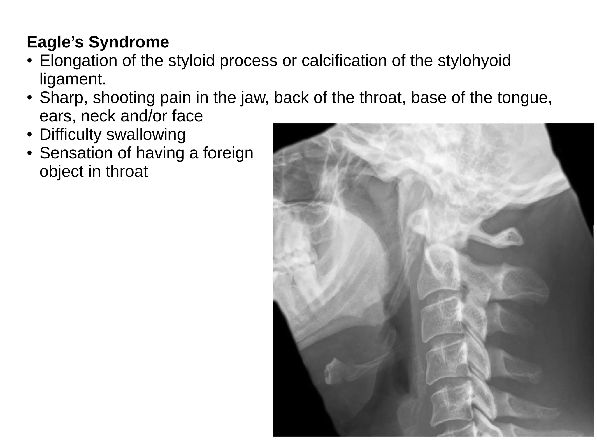 Eagle’s Syndrome
● Elongation of the styloid process or calcification of the stylohyoid
ligament.
● Sharp, shooting pain in the jaw, back of the throat, base of the tongue,
ears, neck and/or face
● Difficulty swallowing
● Sensation of having a foreign
object in throat
 