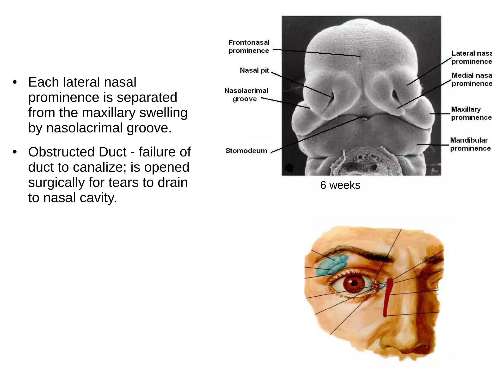 ● Each lateral nasal
prominence is separated
from the maxillary swelling
by nasolacrimal groove.
● Obstructed Duct - failure of
duct to canalize; is opened
surgically for tears to drain
to nasal cavity.
6 weeks
 