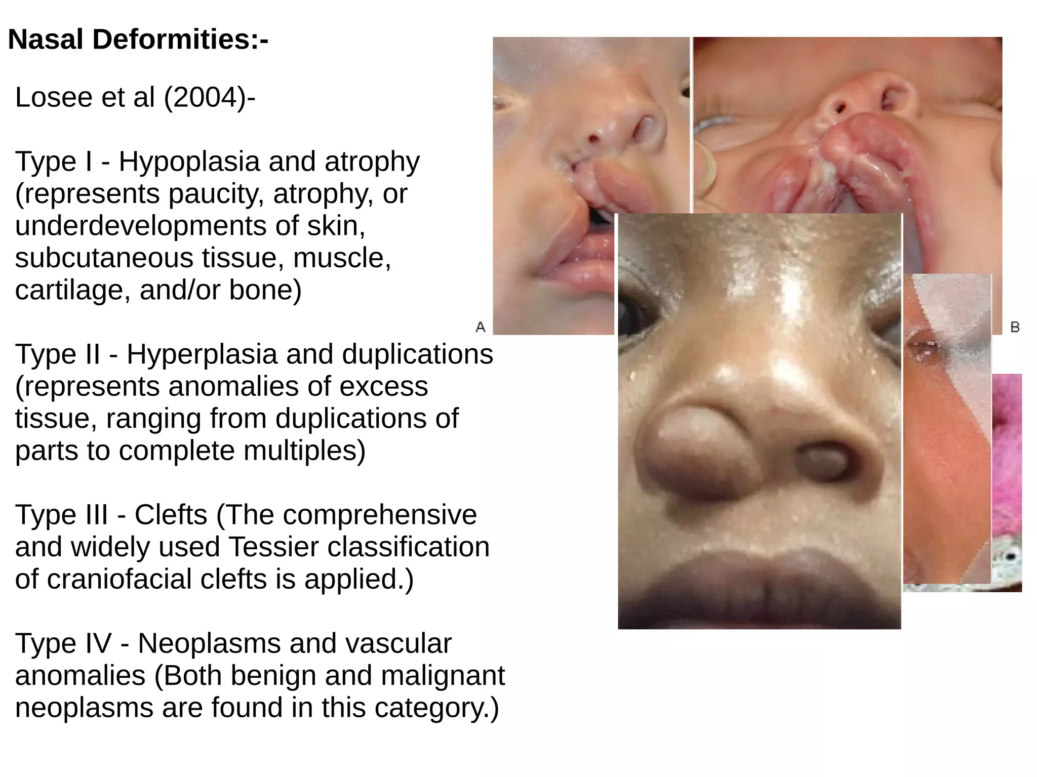 Nasal Deformities:-
Losee et al (2004)-
Type I - Hypoplasia and atrophy
(represents paucity, atrophy, or
underdevelopments of skin,
subcutaneous tissue, muscle,
cartilage, and/or bone)
Type II - Hyperplasia and duplications
(represents anomalies of excess
tissue, ranging from duplications of
parts to complete multiples)
Type III - Clefts (The comprehensive
and widely used Tessier classification
of craniofacial clefts is applied.)
Type IV - Neoplasms and vascular
anomalies (Both benign and malignant
neoplasms are found in this category.)
 