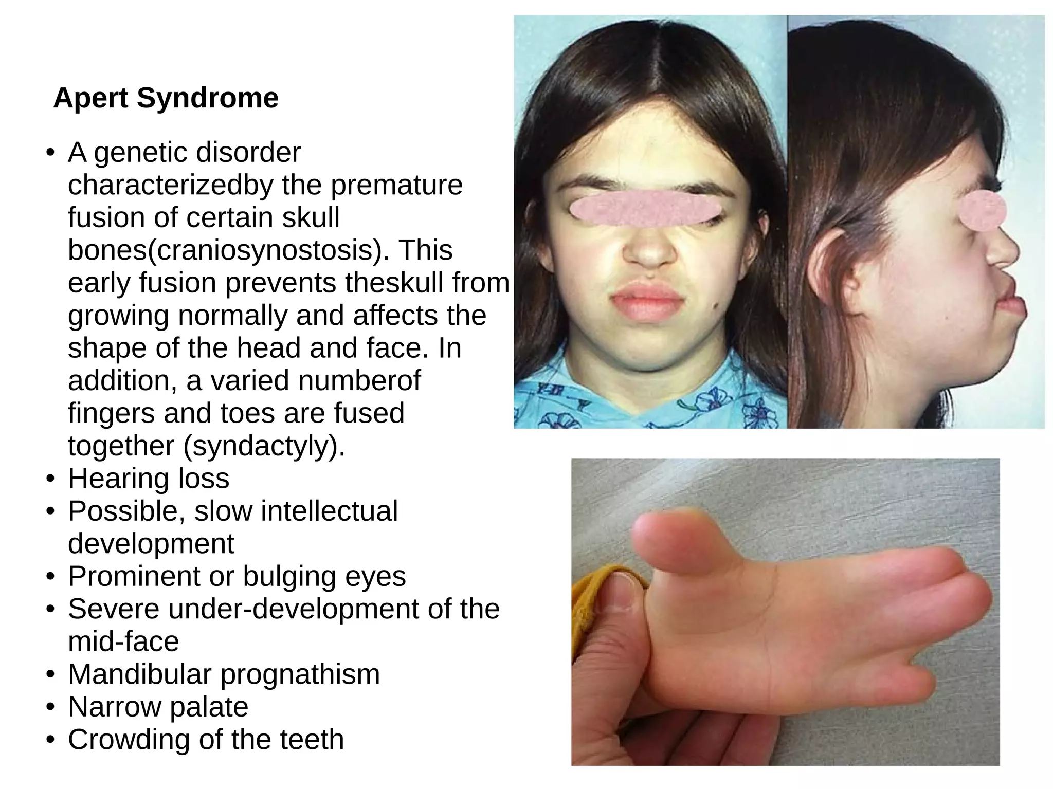 Apert Syndrome
● A genetic disorder
characterizedby the premature
fusion of certain skull
bones(craniosynostosis). This
early fusion prevents theskull from
growing normally and affects the
shape of the head and face. In
addition, a varied numberof
fingers and toes are fused
together (syndactyly).
● Hearing loss
● Possible, slow intellectual
development
● Prominent or bulging eyes
● Severe under-development of the
mid-face
● Mandibular prognathism
● Narrow palate
● Crowding of the teeth
 