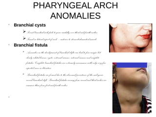 PHARYNGEAL ARCH
ANOMALIES
•
Branchial cysts
➢Second branchial arch fails to grow caudally over third and fourth arches.
➢Found on lateral aspect of neck – anterior to sternocleidomastoid muscle.
•
Branchial fistula
➢
Anomalies in the development of branchial clefts can lead to four unique but
closely related lesions, cysts, external sinuses, internal sinuses and complete
fistulas. Complete branchial fistulas are extremely uncommon with only very few
reported cases in literature.
➢
Branchial fistulae are formed due to the abnormal persistence of the embryonic
second branchial cleft. Branchial fistulae arising from second and third arches are
common than from first and fourth arches.
•
 