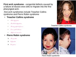 First arch syndrome - congenital defects caused by
a failure of neural crest cells to migrate into the first
pharyngeal arch.
-first arch syndromes include Treacher Collins
syndrome and Pierre Robin syndrome
● Treacher Collins syndrome
➢ Malar hypoplasia
➢ Mandibular hypoplasia
➢ Slanting palpebral fissures
➢ Lower eyelid colobomas
➢ Malformed external ear
● Pierre Robin syndrome
➢ Micrognathia
➢ Cleft palate
➢ Glossoptosis
Treacher Collins syndrome
Pierre Robin syndrome
 