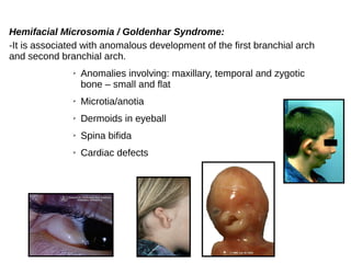 Hemifacial Microsomia / Goldenhar Syndrome:
-It is associated with anomalous development of the first branchial arch
and second branchial arch.
➢ Anomalies involving: maxillary, temporal and zygotic
bone – small and flat
➢ Microtia/anotia
➢ Dermoids in eyeball
➢ Spina bifida
➢ Cardiac defects
 