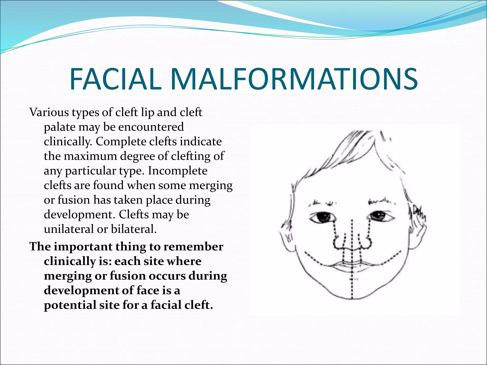 FACIAL MALFORMATIONS
Various types of cleft lip and cleft
palate may be encountered
clinically. Complete clefts indicate
the maximum degree of clefting of
any particular type. Incomplete
clefts are found when some merging
or fusion has taken place during
development. Clefts may be
unilateral or bilateral.
The important thing to remember
clinically is: each site where
merging or fusion occurs during
development of face is a
potential site for a facial cleft.
 