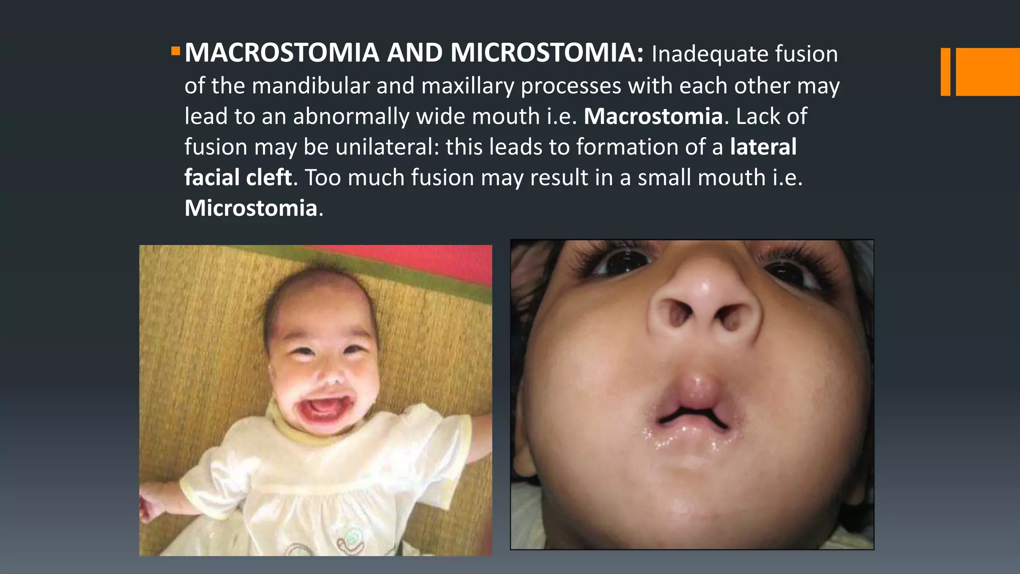 MACROSTOMIA AND MICROSTOMIA: Inadequate fusion
of the mandibular and maxillary processes with each other may
lead to an abnormally wide mouth i.e. Macrostomia. Lack of
fusion may be unilateral: this leads to formation of a lateral
facial cleft. Too much fusion may result in a small mouth i.e.
Microstomia.
 