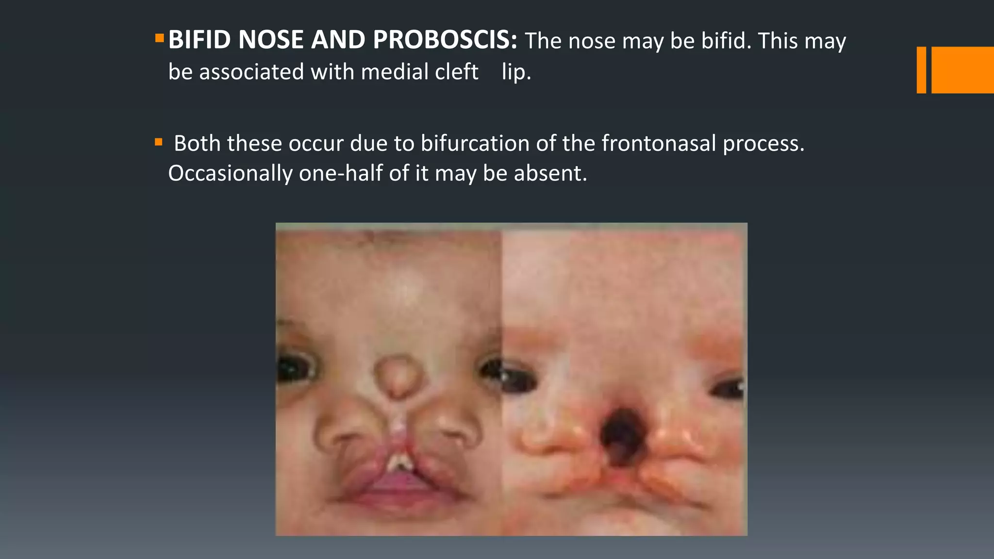 BIFID NOSE AND PROBOSCIS: The nose may be bifid. This may
be associated with medial cleft lip.
 Both these occur due to bifurcation of the frontonasal process.
Occasionally one-half of it may be absent.
 