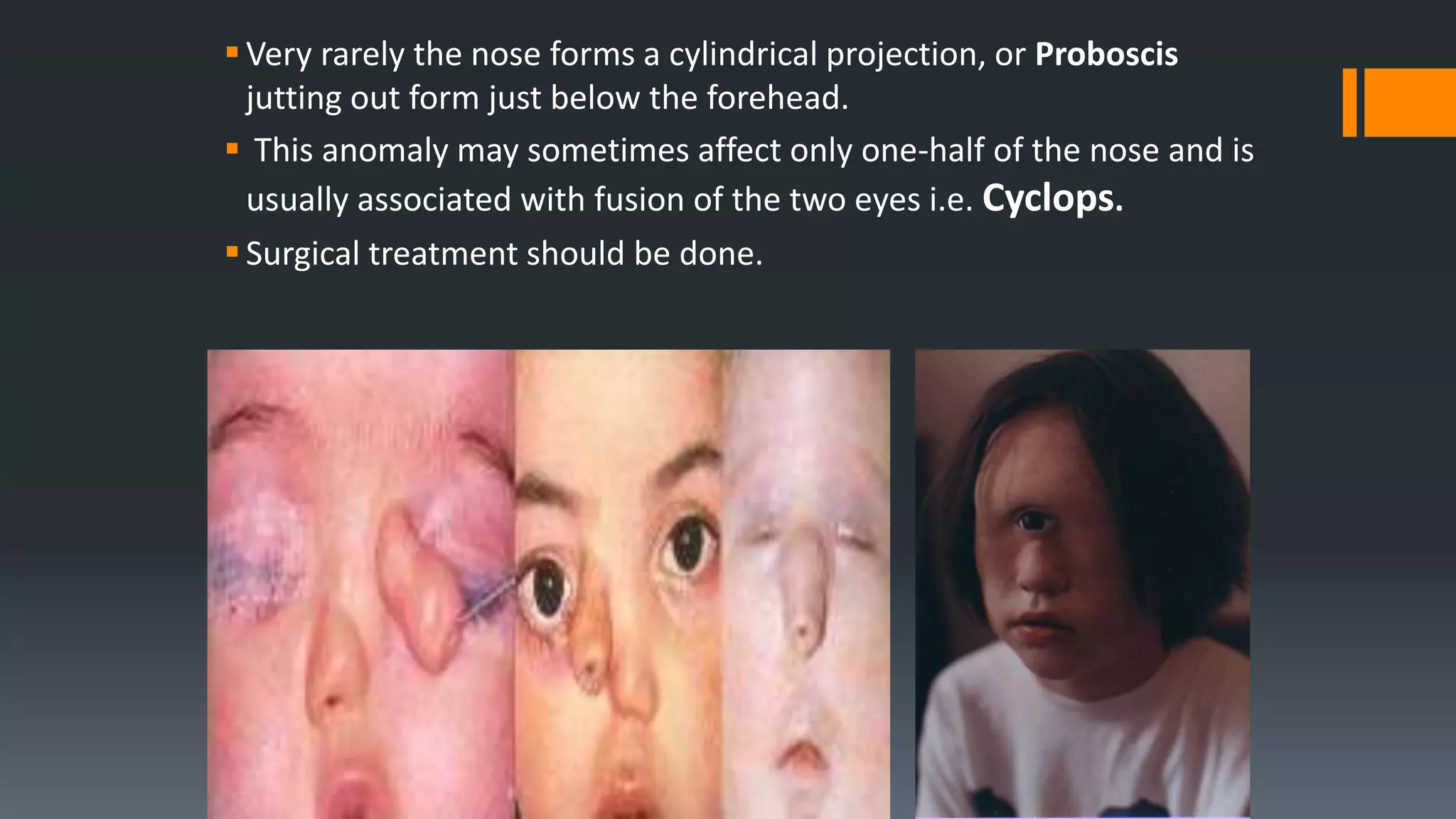 Very rarely the nose forms a cylindrical projection, or Proboscis
jutting out form just below the forehead.
 This anomaly may sometimes affect only one-half of the nose and is
usually associated with fusion of the two eyes i.e. Cyclops.
Surgical treatment should be done.
 