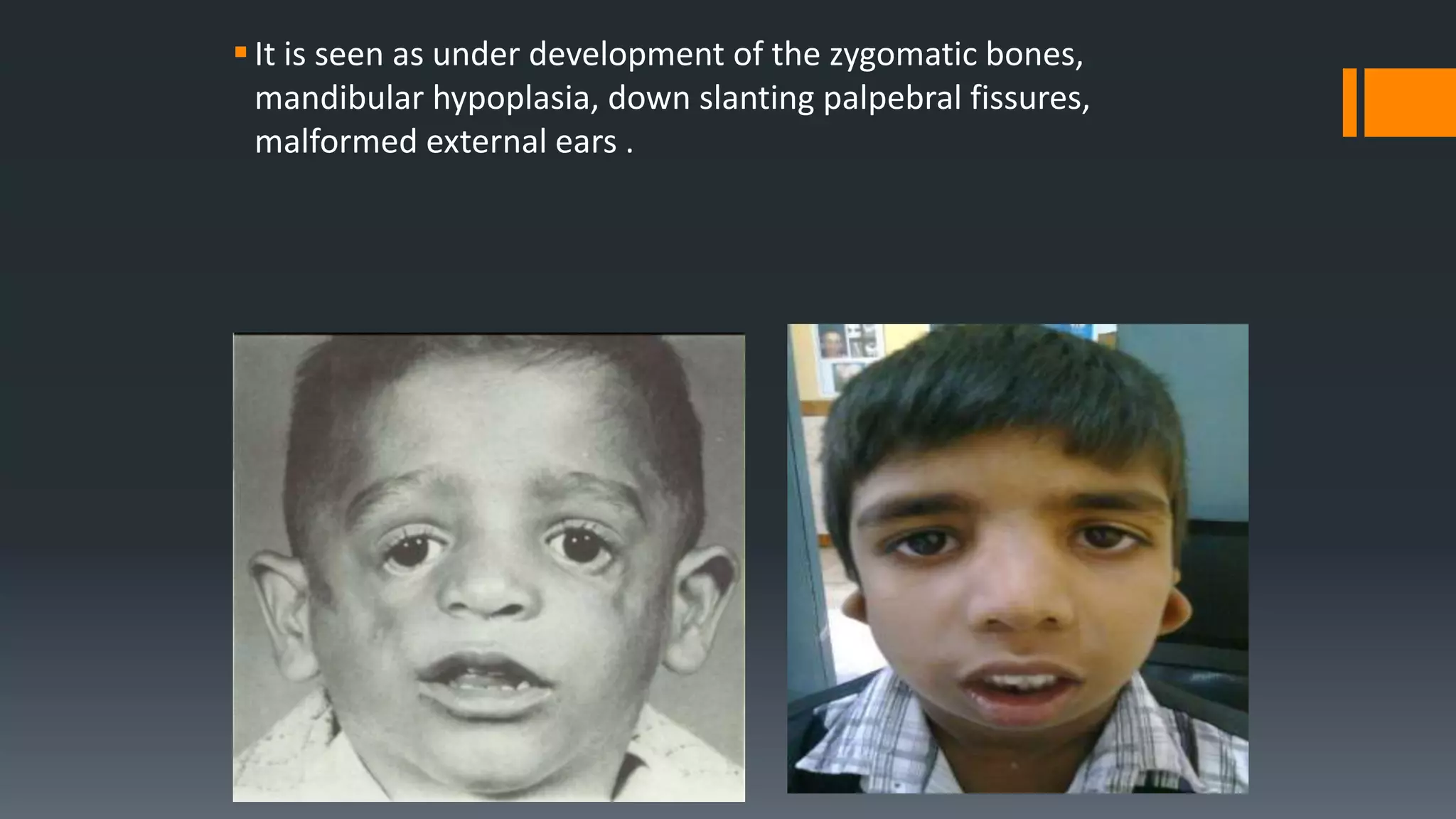It is seen as under development of the zygomatic bones,
mandibular hypoplasia, down slanting palpebral fissures,
malformed external ears .
 