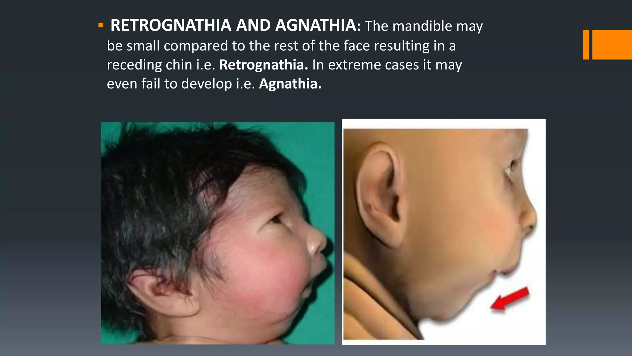  RETROGNATHIA AND AGNATHIA: The mandible may
be small compared to the rest of the face resulting in a
receding chin i.e. Retrognathia. In extreme cases it may
even fail to develop i.e. Agnathia.
 