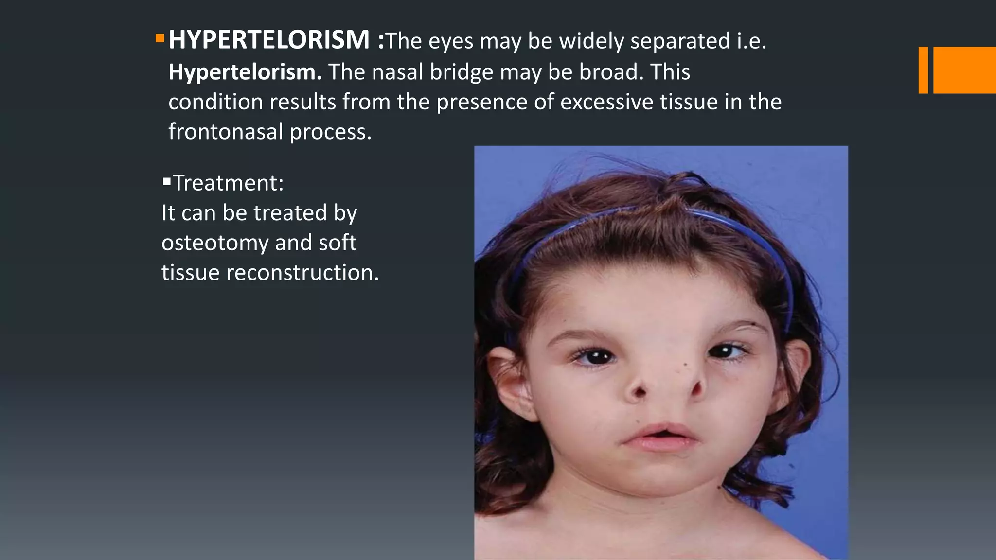 HYPERTELORISM :The eyes may be widely separated i.e.
Hypertelorism. The nasal bridge may be broad. This
condition results from the presence of excessive tissue in the
frontonasal process.
Treatment:
It can be treated by
osteotomy and soft
tissue reconstruction.
 