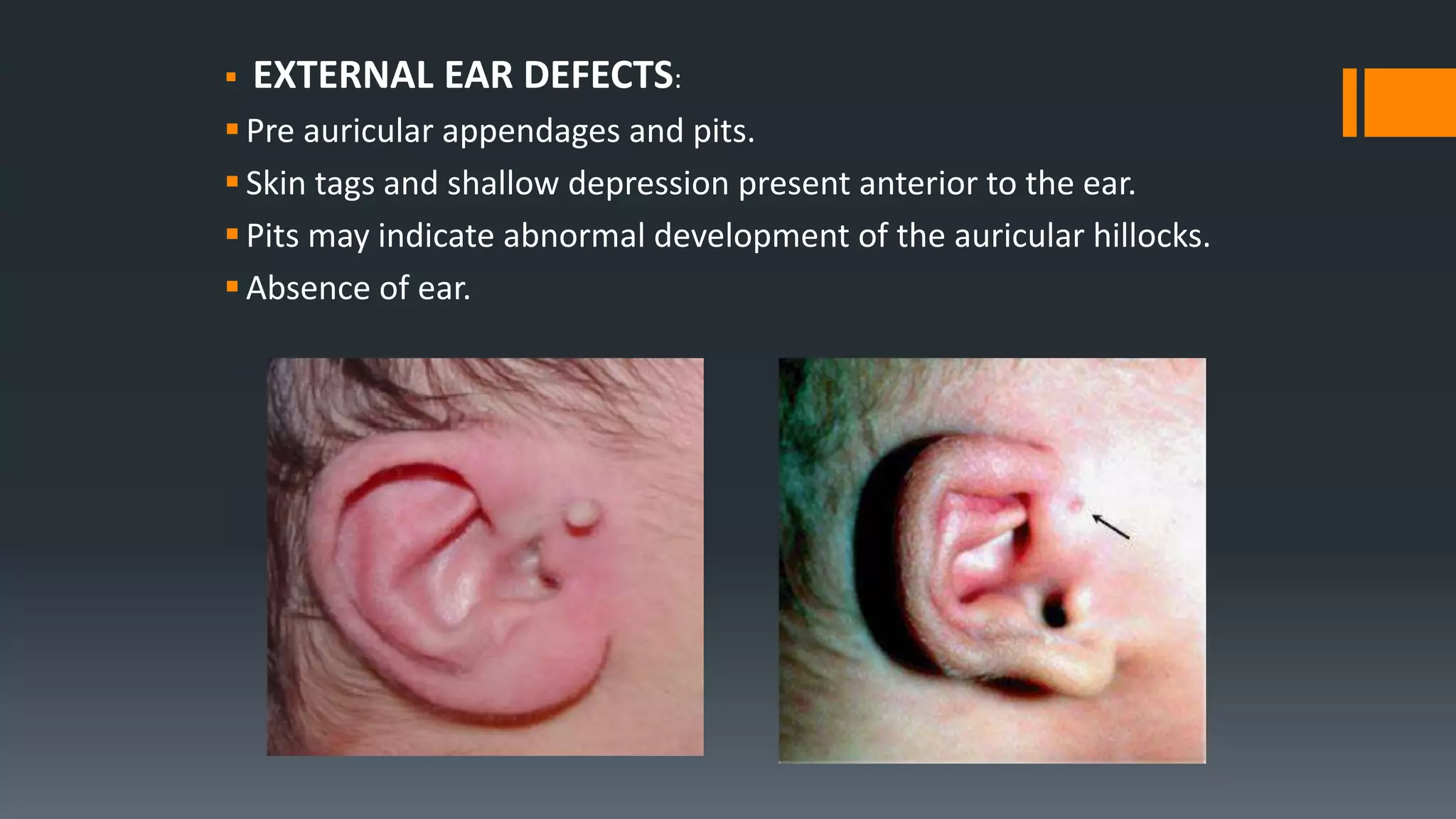  EXTERNAL EAR DEFECTS:
Pre auricular appendages and pits.
Skin tags and shallow depression present anterior to the ear.
Pits may indicate abnormal development of the auricular hillocks.
Absence of ear.
 