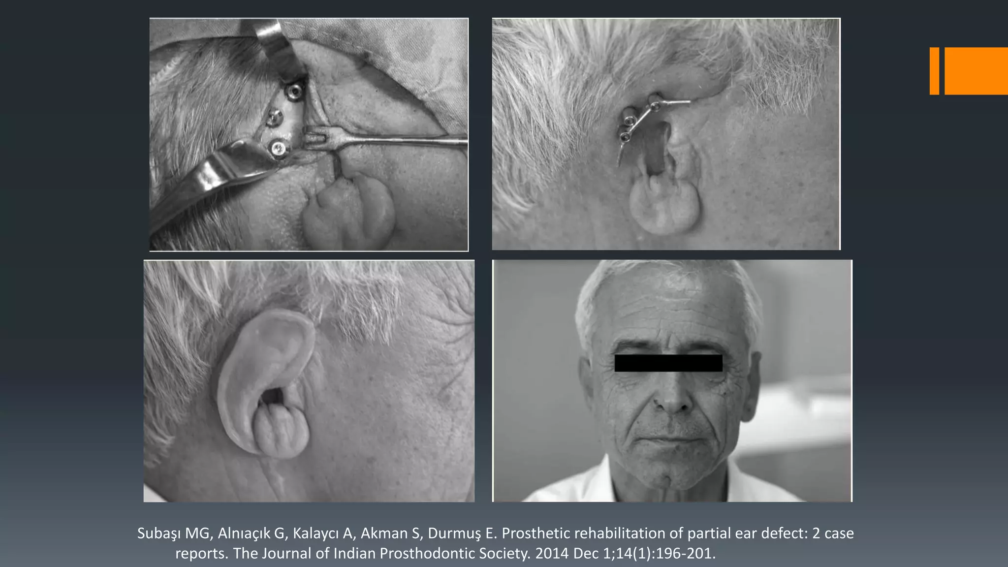 Subaşı MG, Alnıaçık G, Kalaycı A, Akman S, Durmuş E. Prosthetic rehabilitation of partial ear defect: 2 case
reports. The Journal of Indian Prosthodontic Society. 2014 Dec 1;14(1):196-201.
 