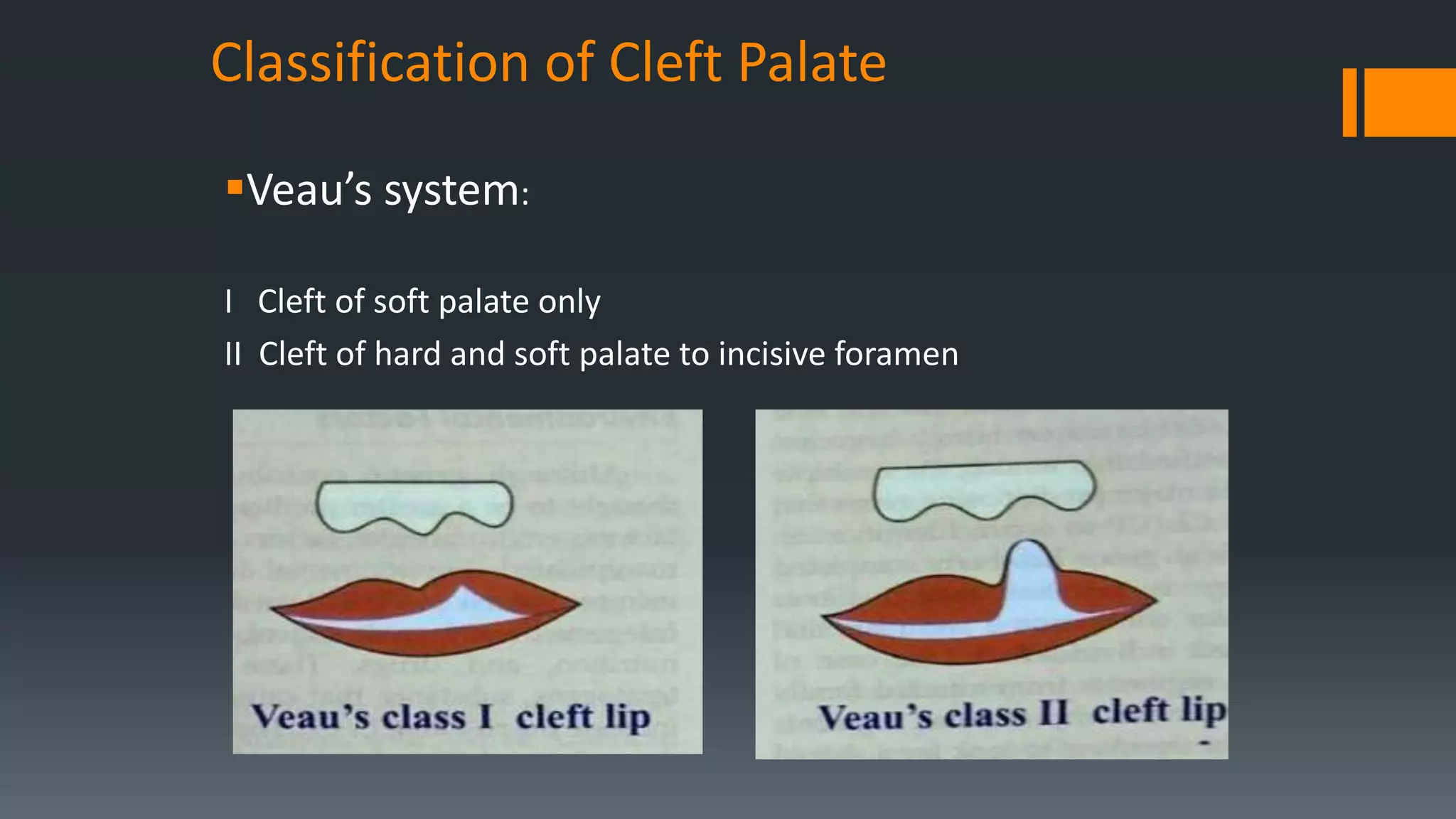 Classification of Cleft Palate
Veau’s system:
I Cleft of soft palate only
II Cleft of hard and soft palate to incisive foramen
 