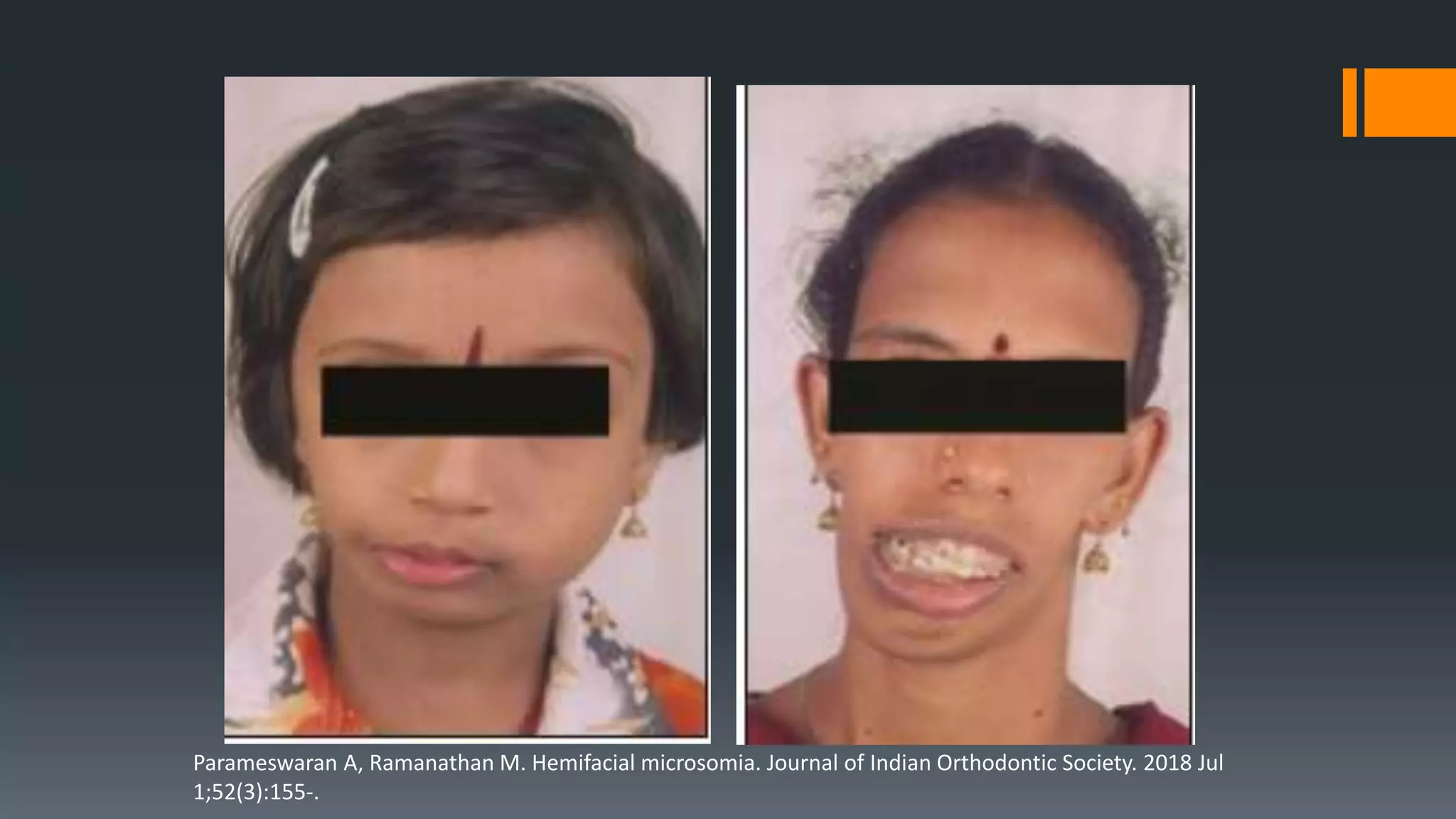 Parameswaran A, Ramanathan M. Hemifacial microsomia. Journal of Indian Orthodontic Society. 2018 Jul
1;52(3):155-.
 