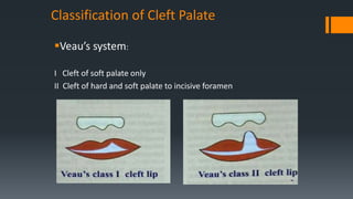 Development of face and palate | PPTX
